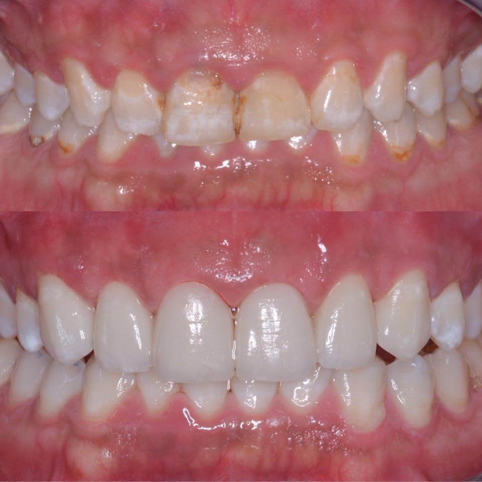 Gum surgery