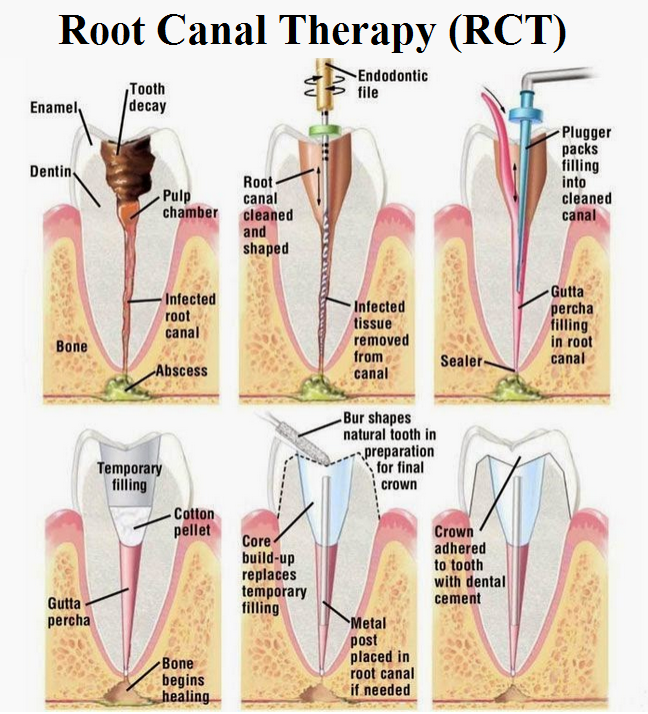 Root-canal-treatment