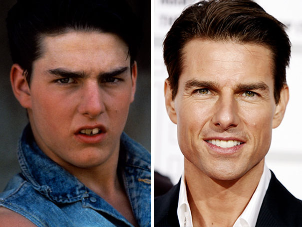 dental-braces-before-after-177-592681230fb48__605
