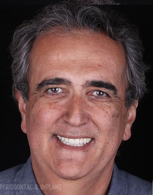 Tarzana-Dental-Implant-before-and-after-1 – Copy Tarzana-Dental-Implant-before-and-after-1 - Copy