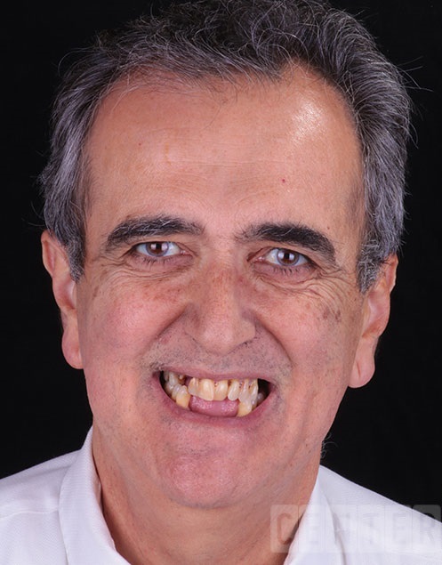 Tarzana-Dental-Implant-before-and-after-1 Tarzana-Dental-Implant-before-and-after-1